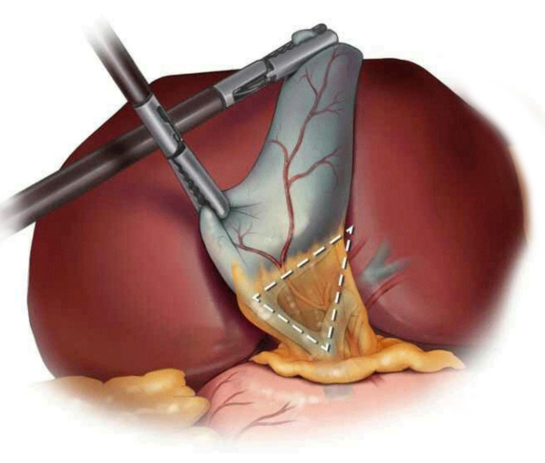 gallbladder stones surgery
