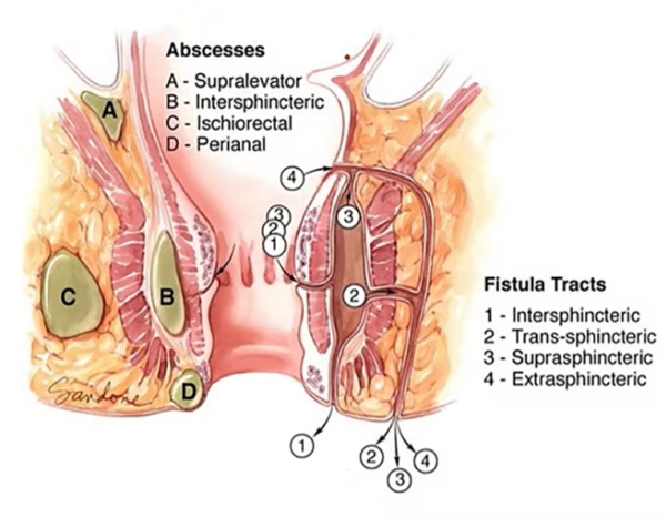 anal fistula treatment