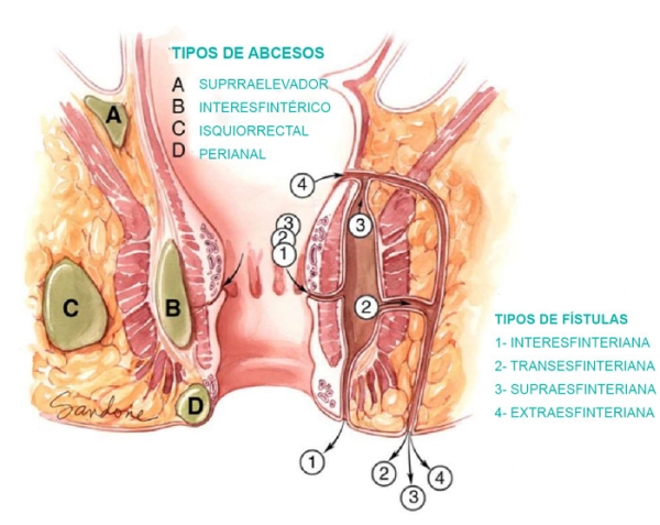 fistula anal tratamiento